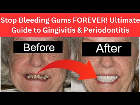 How to Stop Bleeding Gums Gingivitis Periodontitis| Ultimate Guide to Gingivitis & Periodontitis