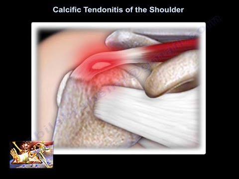 Calcific Tendonitis of the shoulder - Everything You Need To Know - Dr. Nabil Ebraheim