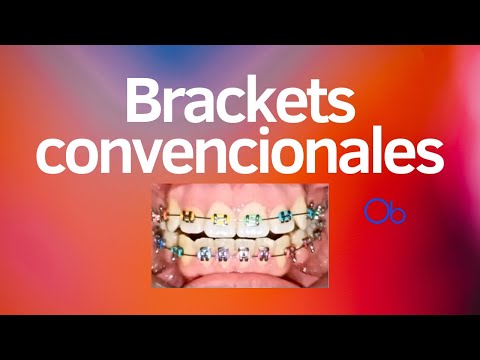 Brackets convencionales metálicos