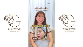 สิวเห่อจนเป็นหลุมสิว