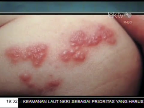 Cara yang efektif untuk meningkatkan potensi Impotensi dimulai dengan prostatitis