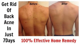 Get Rid Of Back Acne In Just 7 Days || 100% Effective Home Remedy
