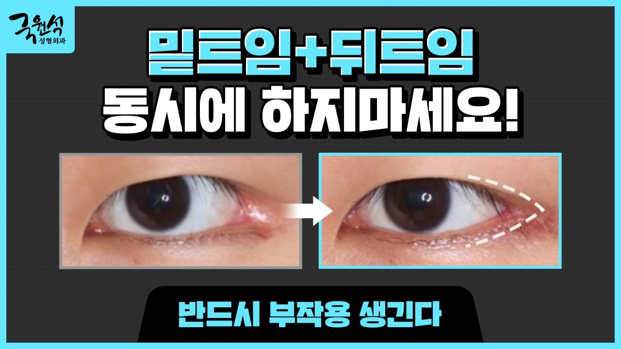 밑트임, 뒤트임 동시에 하지마세요 - 추천 영상