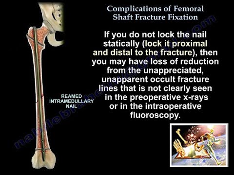 Complications of Femoral Shaft Fracture Fixation - Everything You Need To Know - Dr. Nabil Ebraheim