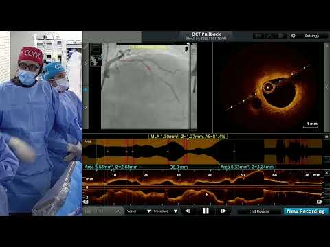 TIO - Complex PCI of a Calcified Lesion
