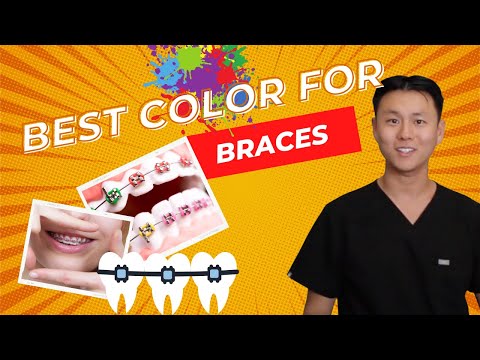 What's the BEST COLOR for my BRACES? | Most Aesthetic...