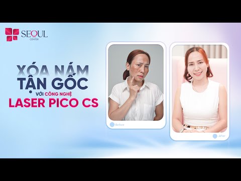 Cảm Nhận Sau Quá Trình Trị Nám Laser Pico SC Của Khách Hàng