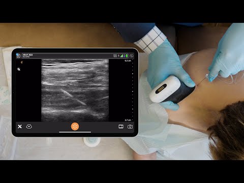 Ultrasound Anatomy of the Proximal Suprascapular Nerve