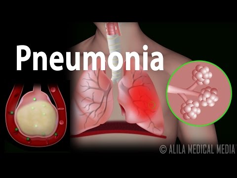 Pneumonia, Animation