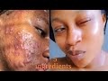 How to Remove Stubborn pimples|Dark spots|Acne|Fast!!! 5 ingredients| Get a Glass skin#clear#acne