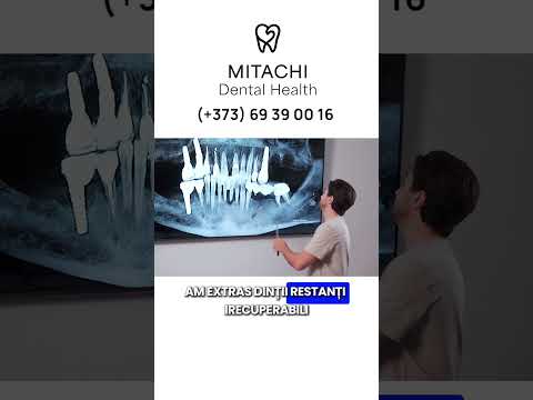 Clinica Dr Mitachi - Caz clinic tratat cu ajutorul la Dantura Fixă