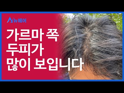 가르마 쪽 두피가 많이 비쳐 보입니다. 탈모인가요?   l 우리끼리 탈밍아웃 l 뉴헤어