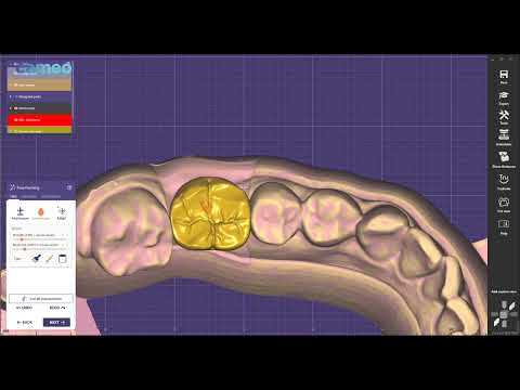 Aidite Exocad design guide: Implant crown design