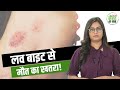 Love Bite यानी Hickey से हो सकती है मौत आखिर इतनी 