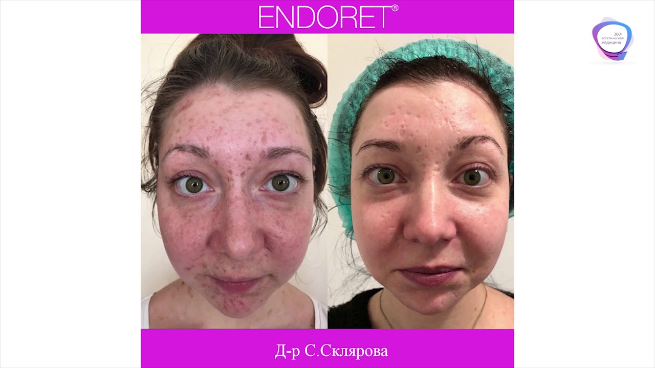 Лечение рубцов после ветрянки: клинический случай