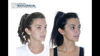 Cirugía ortognática monomaxilar. Caso # 63: María- Clase 3, mordida cruzada