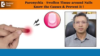 SWOLLEN TISSUE around Nails|PARONYCHIA-Causes, Prevention & Treatment-Dr.Nischal K C|Doctors