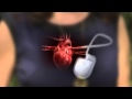 Defibrillator-Pacemaker: What's the Difference ...