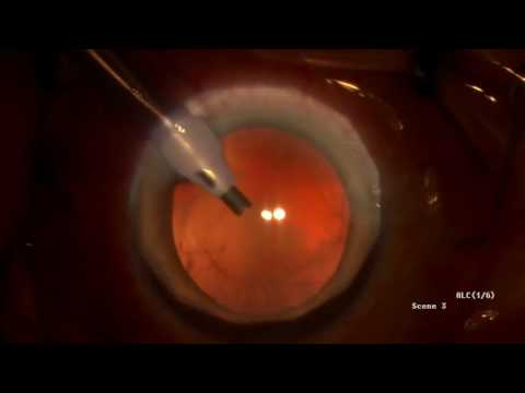 phaco PSCC Physiol lens by DR an Haddadin