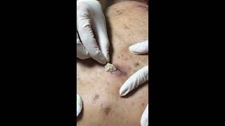 Squeeze &amp; Pop (Cyst # 2 )