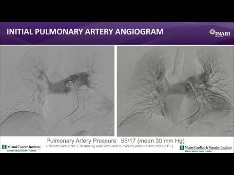 Mechanical Thrombectomy for Pulmonary Embolism: Case Examples