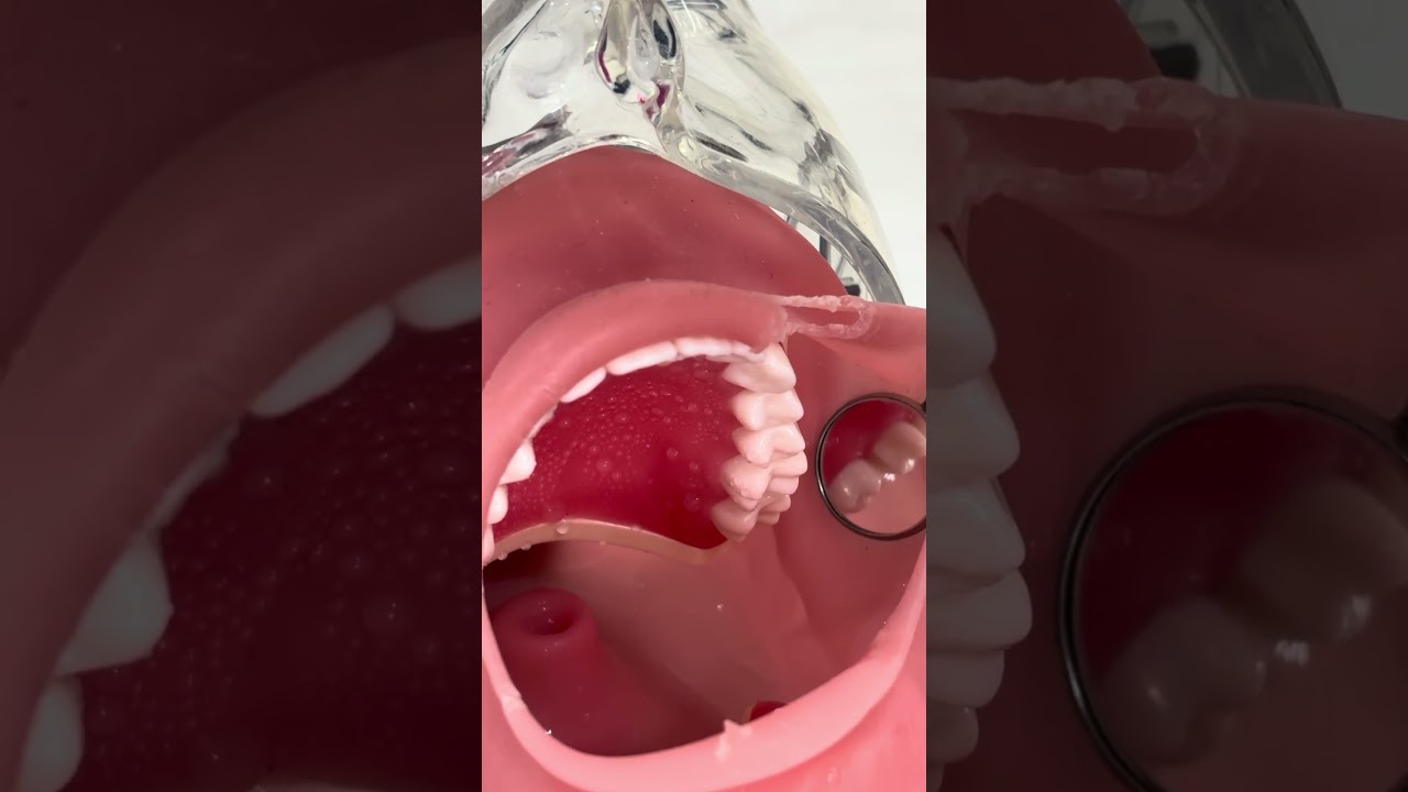 マンツーマンセミナー：左上6番支台歯形成(3/14)講師によるスライスカットしきれなかった部分を削除する方法デモンストレーション①