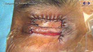 Eyelid Reconstruction Cutler Beard Technique