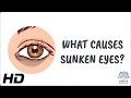 Why Do We Get Sunken Eyes? The Ultimate Guide - Medical Centric Why Do We Get Sunken Eyes? The Ultimate Guide