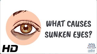 Why Do We Get Sunken Eyes? The Ultimate Guide