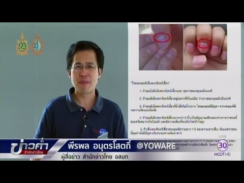 โรคสะเก็ดเงินขี้ผึ้งของฮอร์โมนและราคารักษาของพวกเขา วิดีโอผิวหนังอักเสบ seborrheic