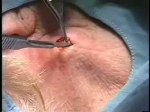 comment soigner un furoncle a l'anus