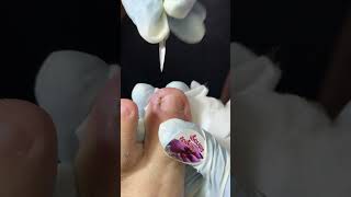 Ep_8169 Foot nail skin removal 👣 Why is there so much skin? 😄 (clip from Thailand)