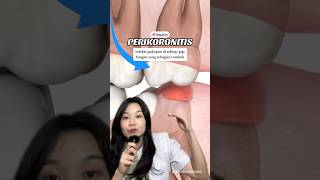 Download lagu GUSI di sekitar Gigi Bungsu SAKIT dan BENGKAK? Lho kok bisa?! mp3 Download lagu GUSI di sekitar Gigi Bungsu SAKIT dan BENGKAK? Lho kok bisa?! mp3