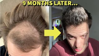 HE RESURRECTED HIS HAIR BACK FROM THE DEAD USING THESE 2 HAIR LOSS TREATMENTS!