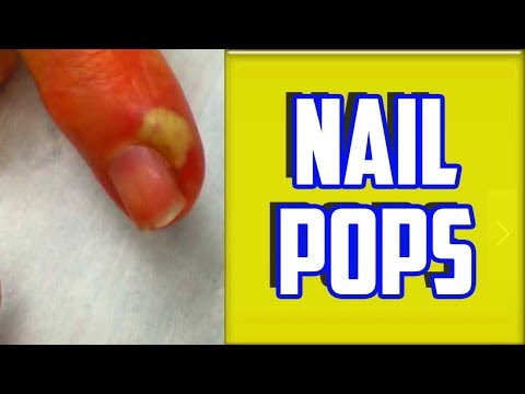 Ano ang gagawin kung balatan-off mo ang kuko sa paa pagkatapos ng isang pinsala paggamot Ang isang tao ay cured fungus