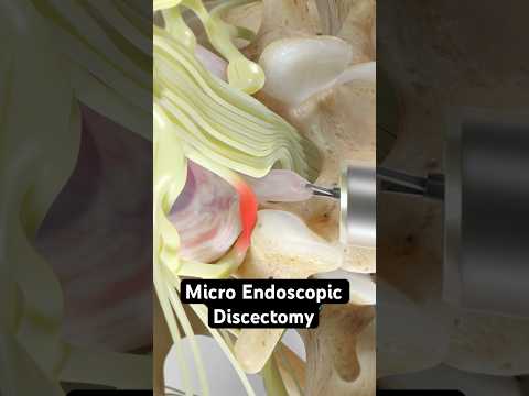 How surgeons relieve herniated disc pain (3D Animation)