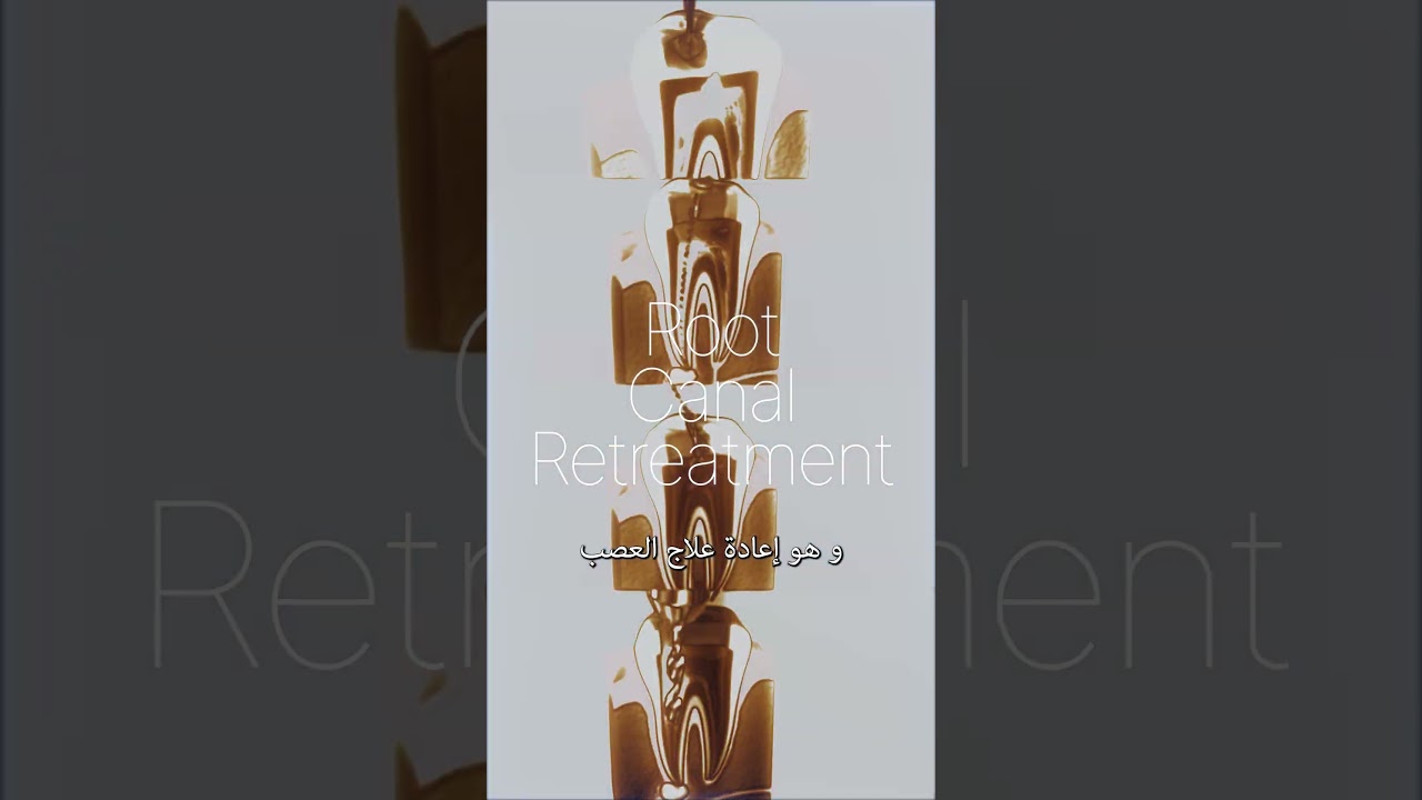 Root canal Dr  Nihad Final