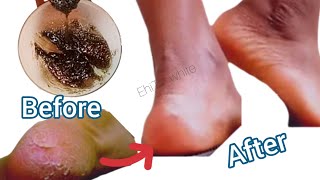 How To Exfoliate, Remove Dead Skin From Your Feet Naturally At Home Remedy/No More Cracked Dry Heels