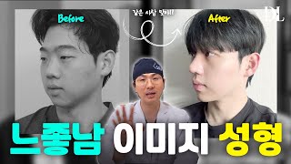 얼굴이 이렇게 바뀐다고? 남자 성형 리얼케이스 공개