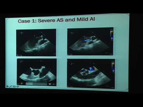 20180824_30_ Radiation_Induced_Valvular_Heart_Disease_Soma_Konety_Dr