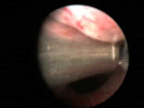 UroLift procedure video