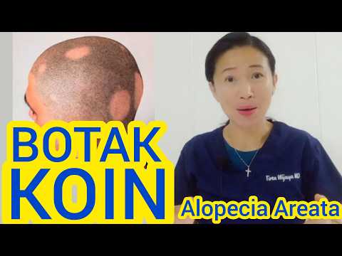 Botak / Pitak Koin - Alopecia Areata @drtirtawatiwijaya