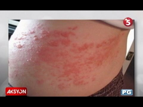 Sonnik fungus toenails hiwa Epektibong paraan ng yodo kuko halamang-singaw