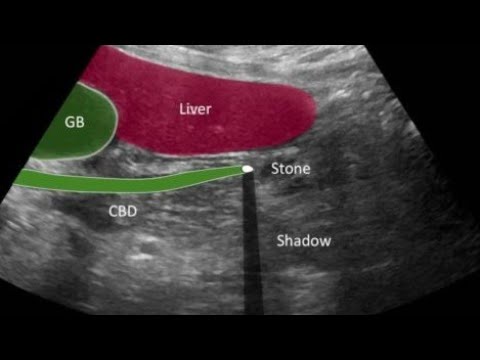 Gallbladder Stone Ultrasound