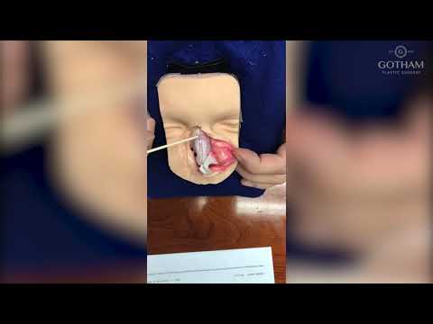 Rhinoplasty Procedure Explained by Dr. Miller
