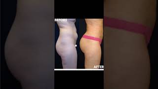 #transformationthursday at MiKO Plastic Surgery Beverly Hills