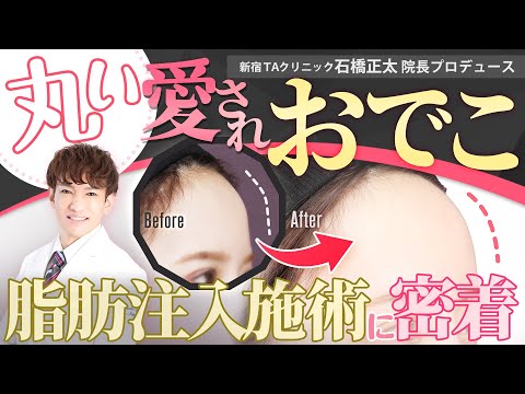 【まんまるおでこ】脂肪注入の名医！Dr.石橋による額の脂肪注入ーオルチャンデコ形成ーに密着【TAクリニック】