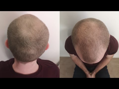 Pumpkin Seed Oil for Hair Loss (24 Week Experiment)