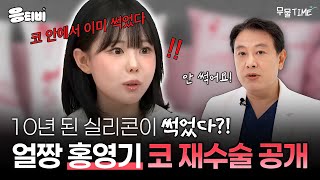 1세대 얼짱 ‘홍영기‘ 코 재수술한 이유❓｜코성형｜김종구 원장