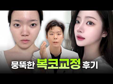 복코교정 케이스, 진성복코·가성복코 원인부터 콧망울 개선까지 ㅣ디에이성형외과ㅣ콧망울넓은코교정